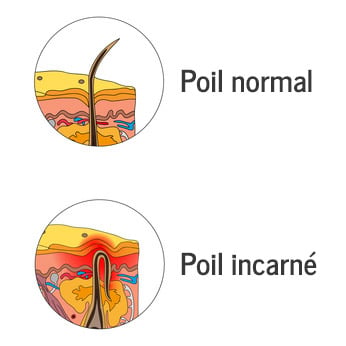 Schéma poil normal et poil incarné