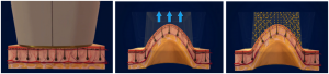 fonctionnement-lightsheer-duet-option-dermasante