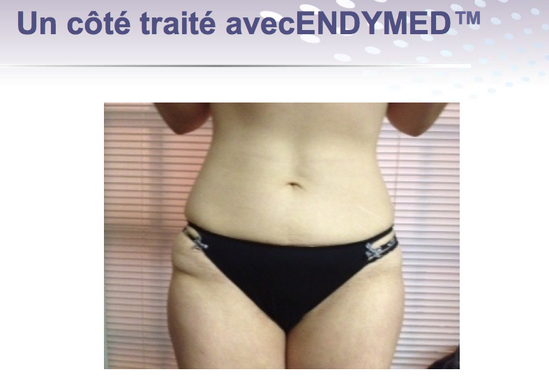 cote du corps endymed