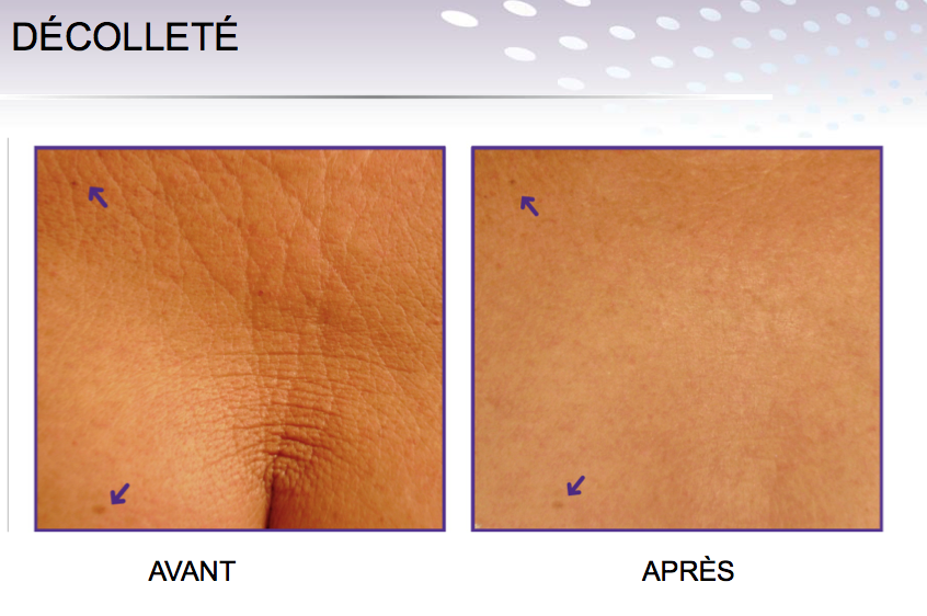 decollete endymed 3 deep