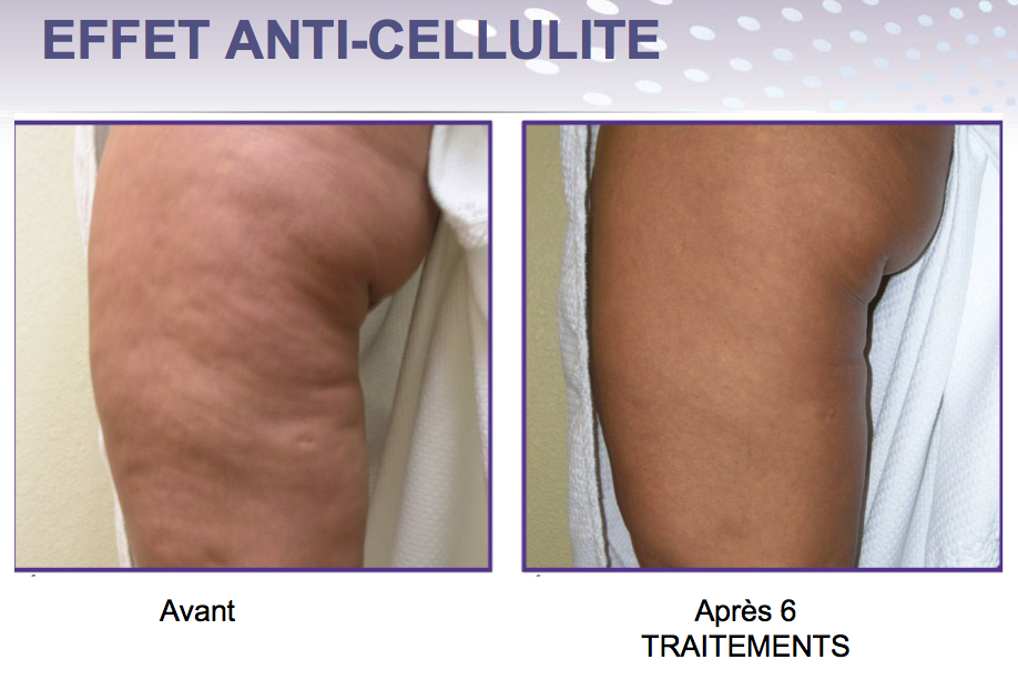 endymed 3 deep cellulite cuisses et fesses
