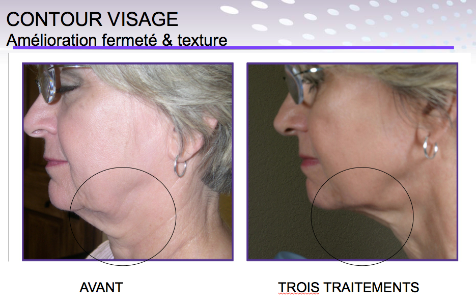 endymed 3 deep contour du visage