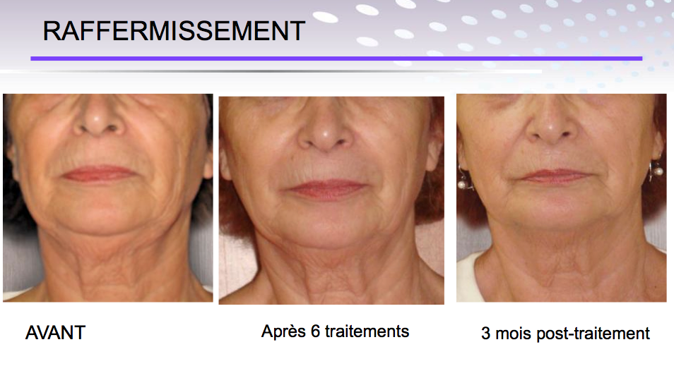 endymed 3 depp raffermissement visage