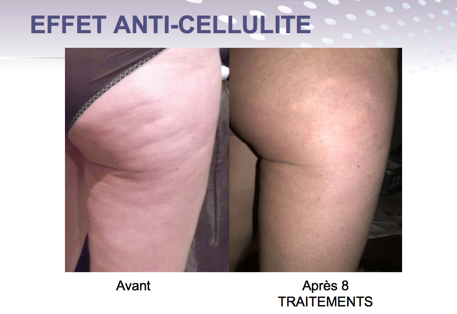 endymeed 3 deep fesses et cuisses