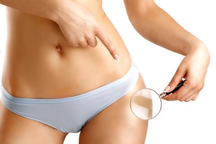 cellulite - Fotolia 66062456 XS