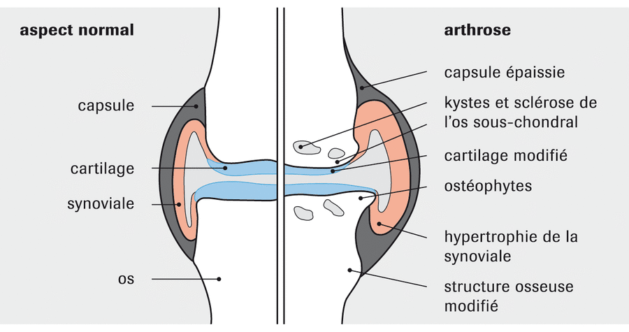 Articulation sans avec arthrose FR Articulation sans avec arthrose FR