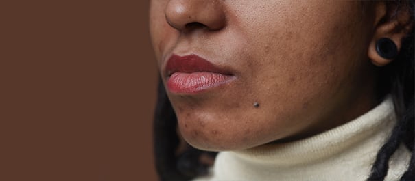 Femme avec des cicatrices d'acné sur le visage.