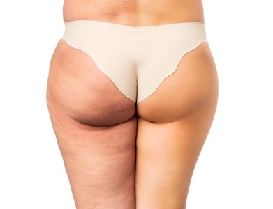 traitement de votre cellulite - Fotolia 74366605 XS