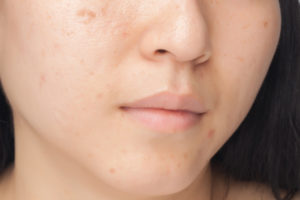 acné au visage