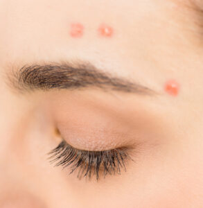 Visage d’une femme avec des boutons d’acné