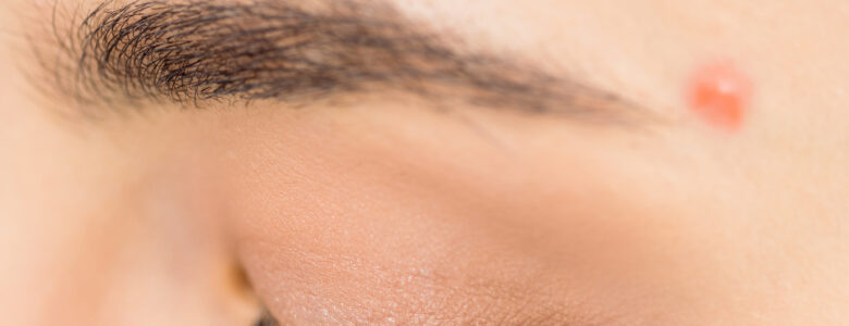 Visage d’une femme avec des boutons d’acné